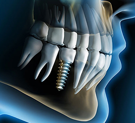 Altınbaş Üniviersitesi Oral Implantology